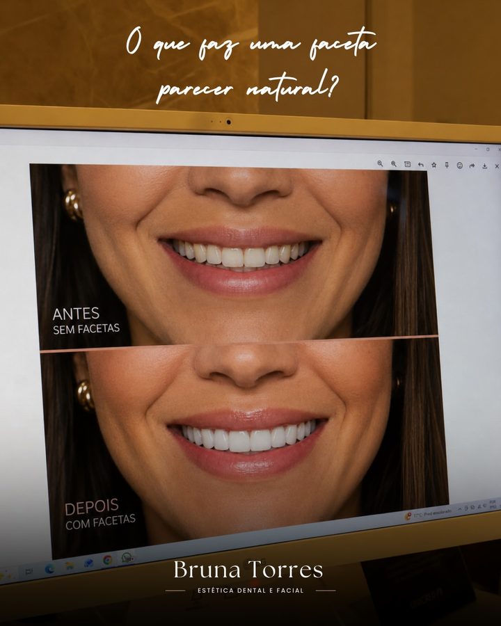 Antes e depois de facetas dentárias feitas pela Bruna Torres